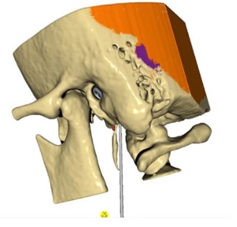 HỆ THỐNG PHẪU THUẬT TAI MŨI ẢO HỖ TRỢ HAPTICS